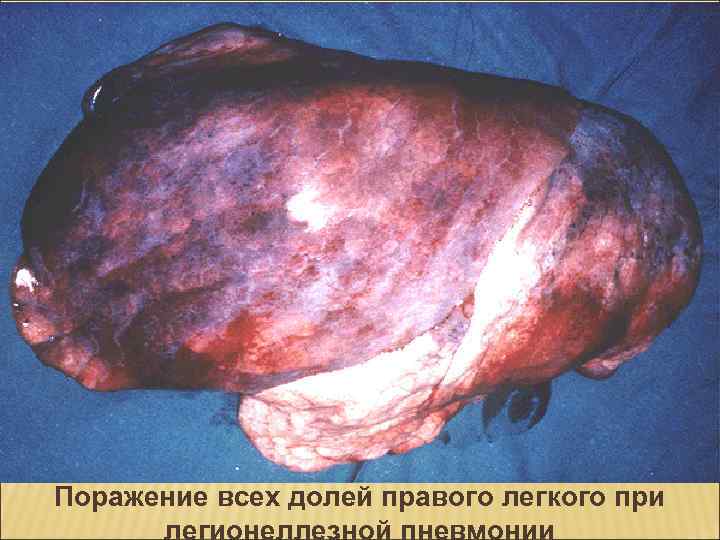 Поражение всех долей правого легкого при легионеллезной пневмонии 