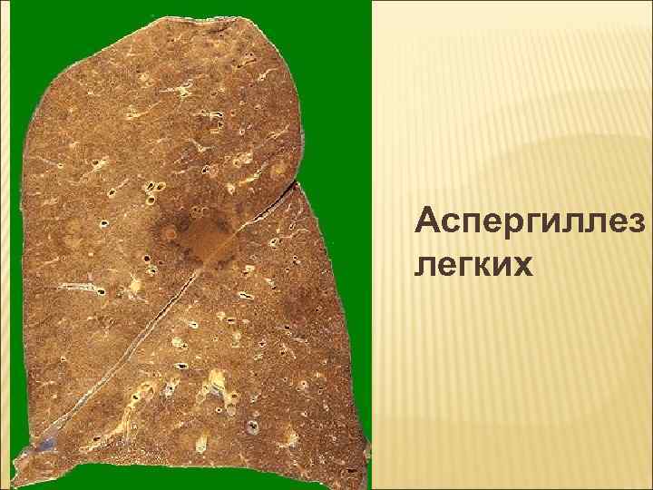 Аспергиллез легких 