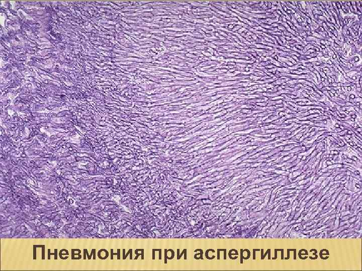 Пневмония при аспергиллезе 
