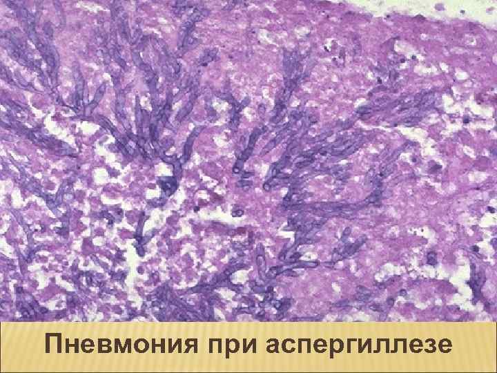 Пневмония при аспергиллезе 
