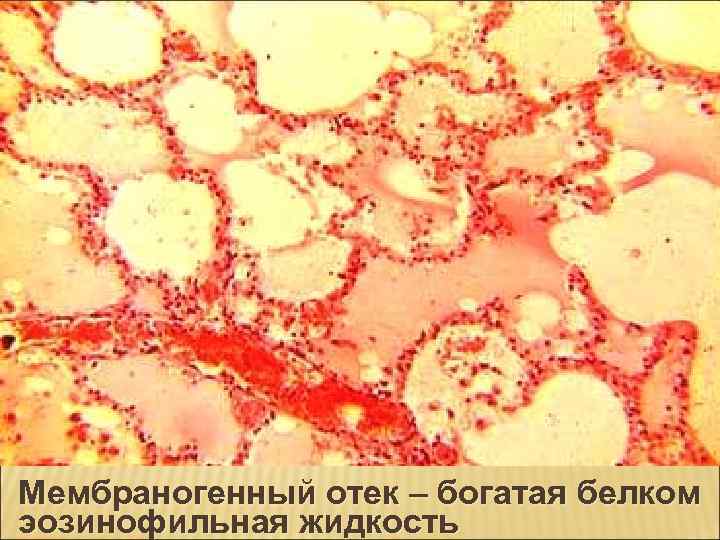 Мембраногенный отек – богатая белком эозинофильная жидкость 