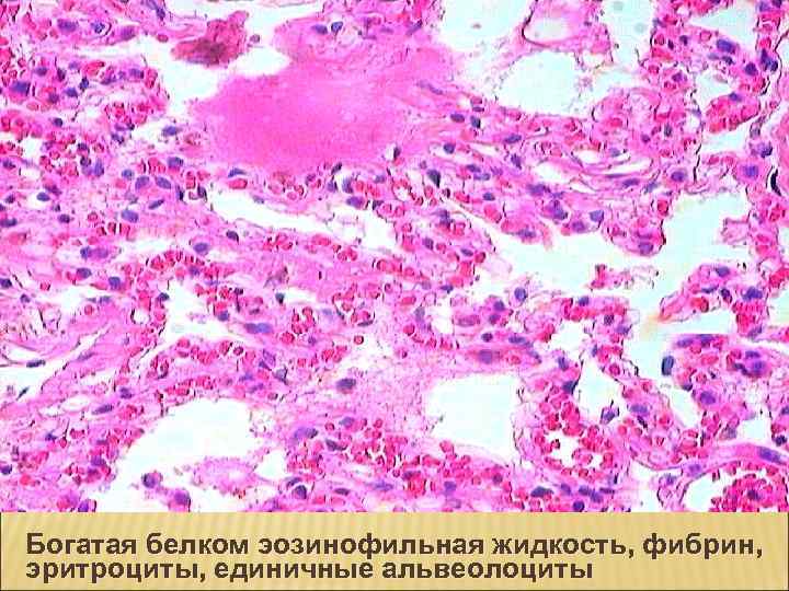 Богатая белком эозинофильная жидкость, фибрин, эритроциты, единичные альвеолоциты 