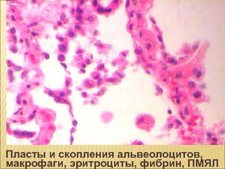 Пласты и скопления альвеолоцитов, макрофаги, эритроциты, фибрин, ПМЯЛ 