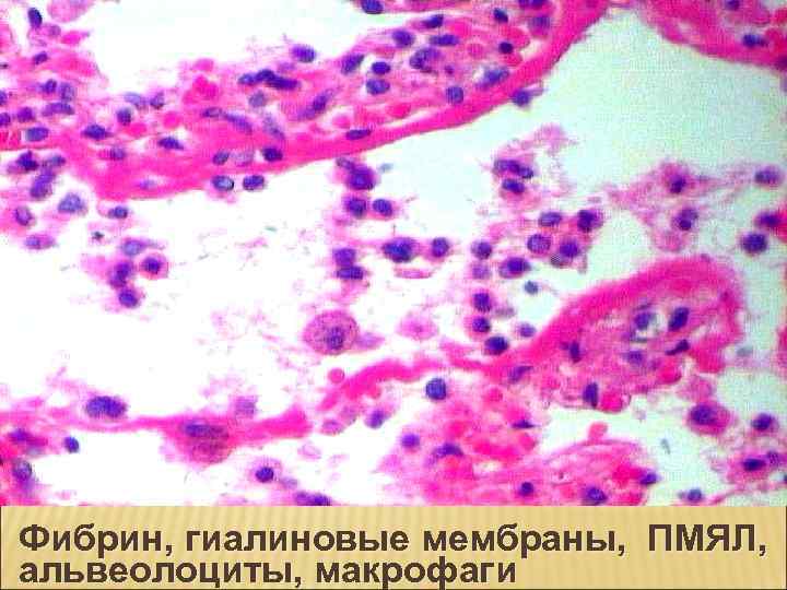 Фибрин, гиалиновые мембраны, ПМЯЛ, альвеолоциты, макрофаги 