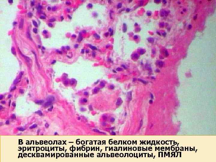 В альвеолах – богатая белком жидкость, эритроциты, фибрин, гиалиновые мембраны, десквамированные альвеолоциты, ПМЯЛ 