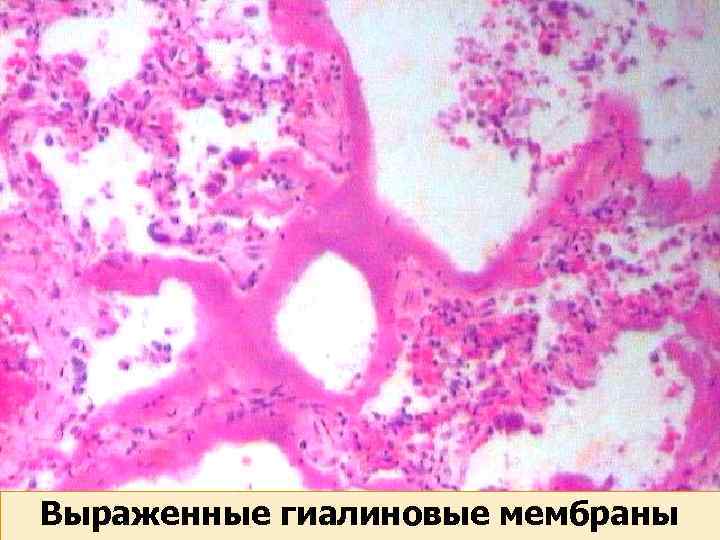 Выраженные гиалиновые мембраны 