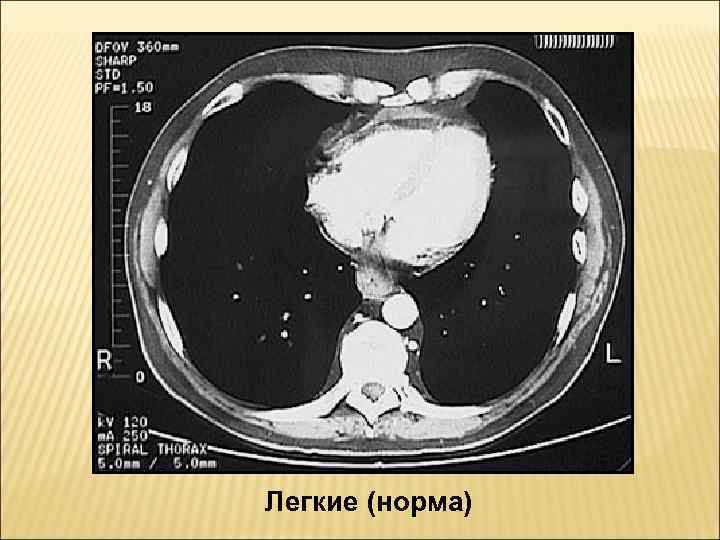 Легкие (норма) 