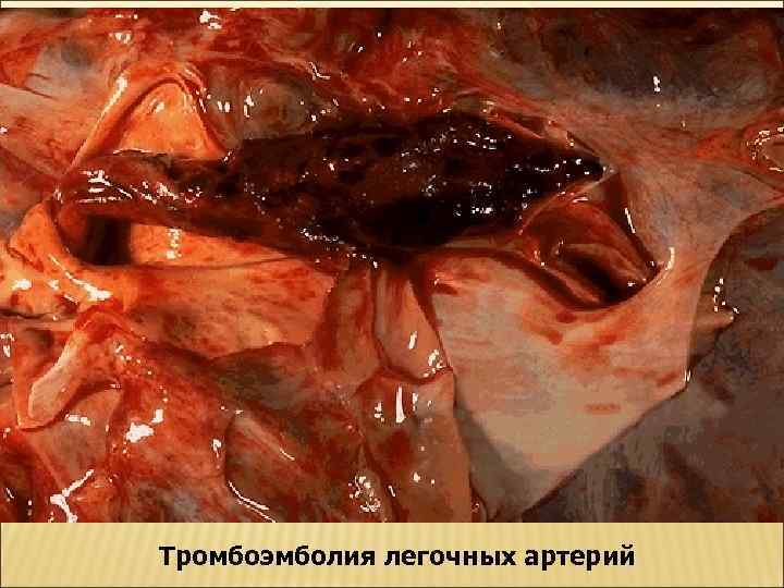 Тромбоэмболия легочных артерий 