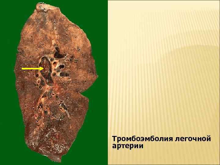 Тромбоэмболия легочной артерии 