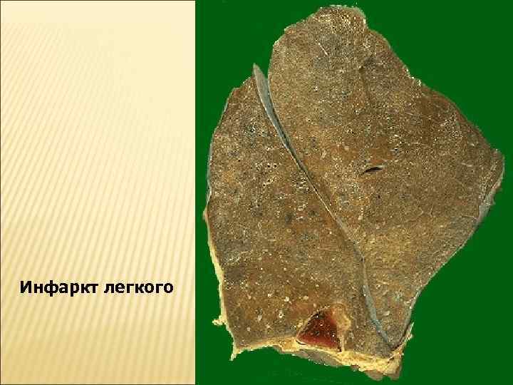 Инфаркт легкого 