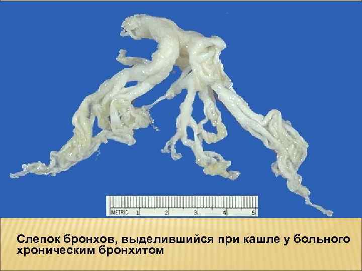 Слепок бронхов, выделившийся при кашле у больного хроническим бронхитом 
