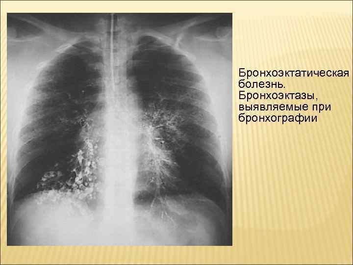 Бэб это. Бронхоэктатическая болезнь бронхография. Бронхоэктатическая болезнь легких рентген. Бронхоэктатическая болезнь рентгенограмма. Рентген бронхоэктатической болезни.