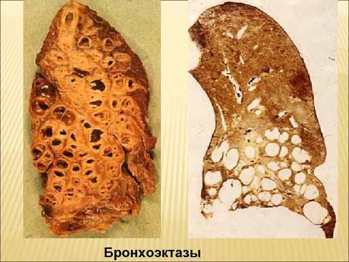 Бронхоэктазы 