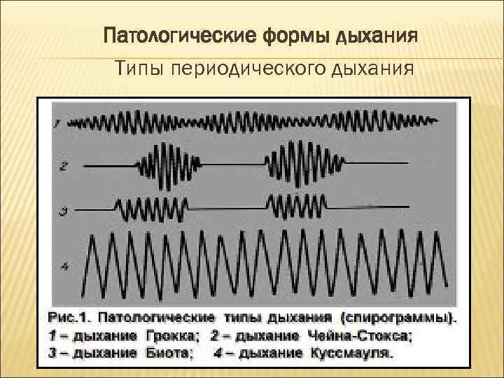 Патологические формы дыхания Типы периодического дыхания 
