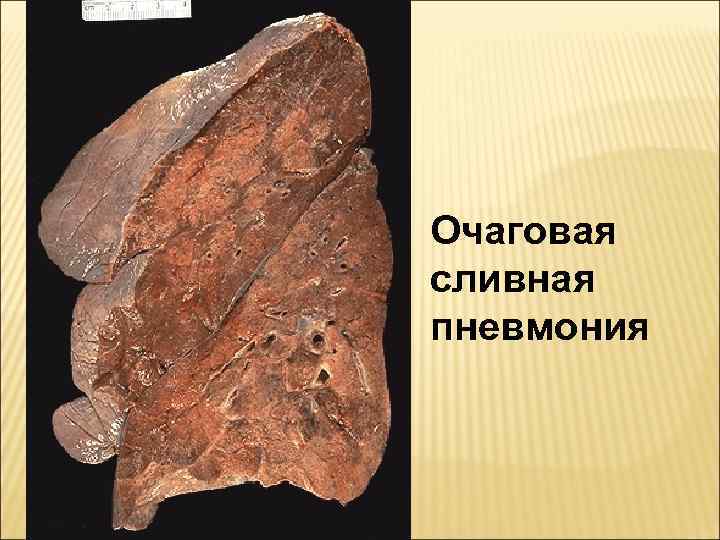 Очаговая сливная пневмония 