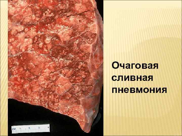 Очаговая сливная пневмония 