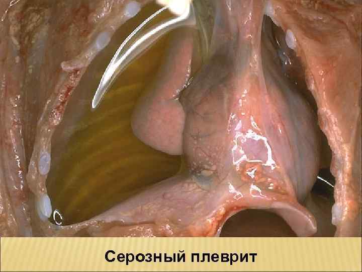 Серозный плеврит 