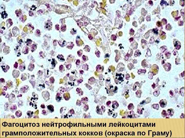 Фагоцитоз нейтрофильными лейкоцитами грамположительных кокков (окраска по Граму) 