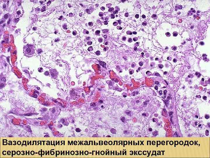 Вазодилятация межальвеолярных перегородок, серозно-фибринозно-гнойный экссудат 