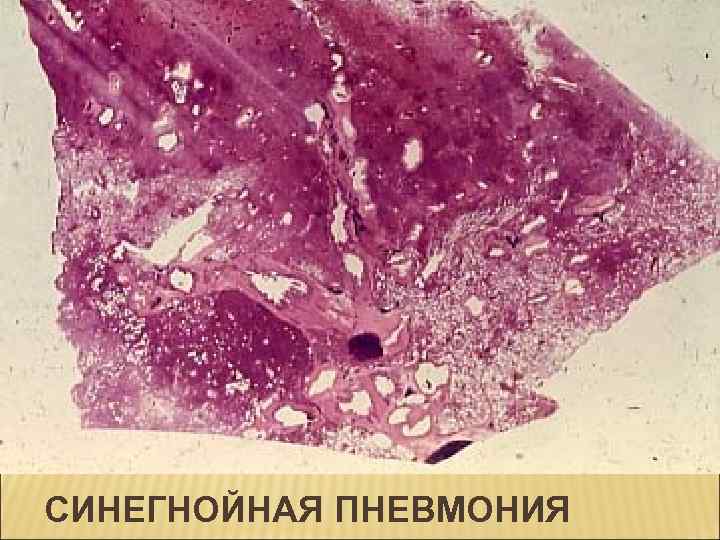 СИНЕГНОЙНАЯ ПНЕВМОНИЯ 