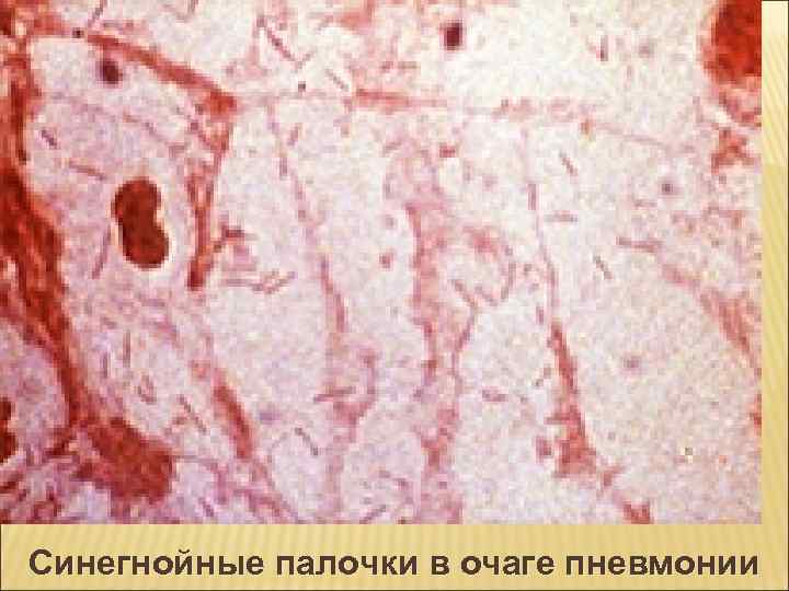 Синегнойные палочки в очаге пневмонии 