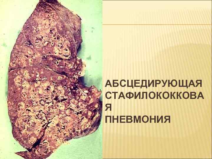 АБСЦЕДИРУЮЩАЯ СТАФИЛОКОККОВА Я ПНЕВМОНИЯ 