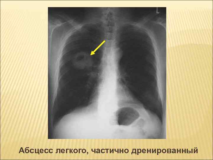 Рентгенологическая картина при абсцессе