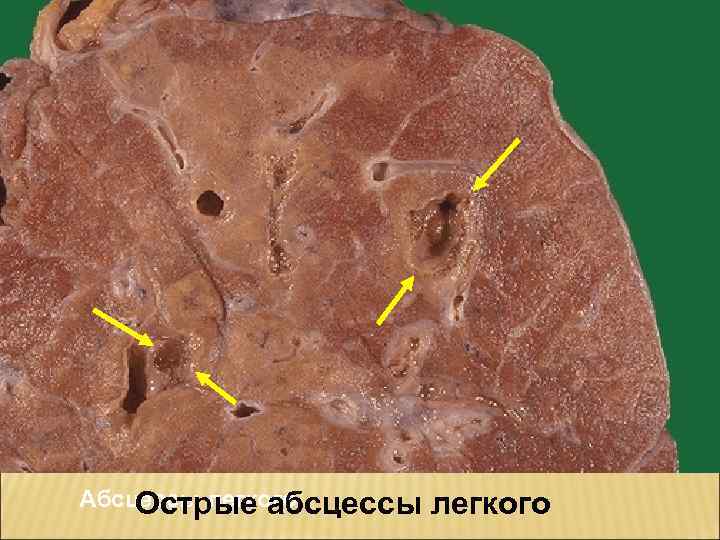 Абсцессы легкого Острые абсцессы легкого 