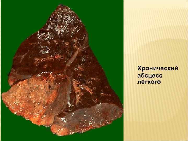 Хронический абсцесс легкого 