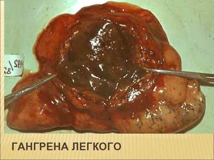 ГАНГРЕНА ЛЕГКОГО 