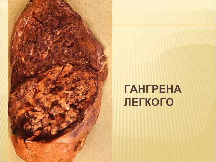 ГАНГРЕНА ЛЕГКОГО 