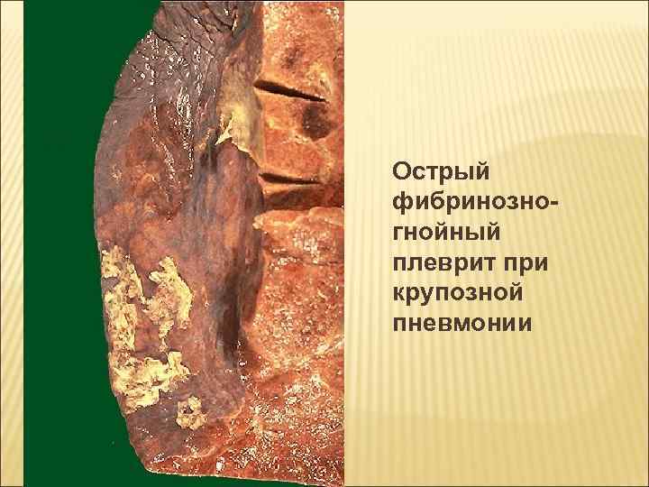 Острый фибринозногнойный плеврит при крупозной пневмонии 