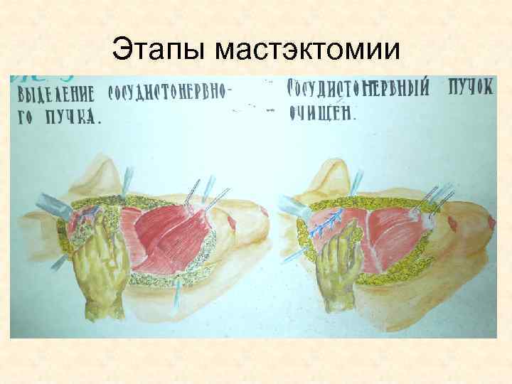 Этапы мастэктомии 