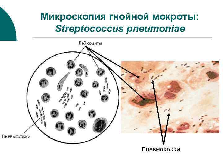 Микроскопия гнойной мокроты: Streptococcus pneumoniae Пневмококки 