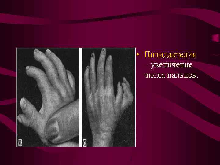  • Полидактелия – увеличение числа пальцев. 
