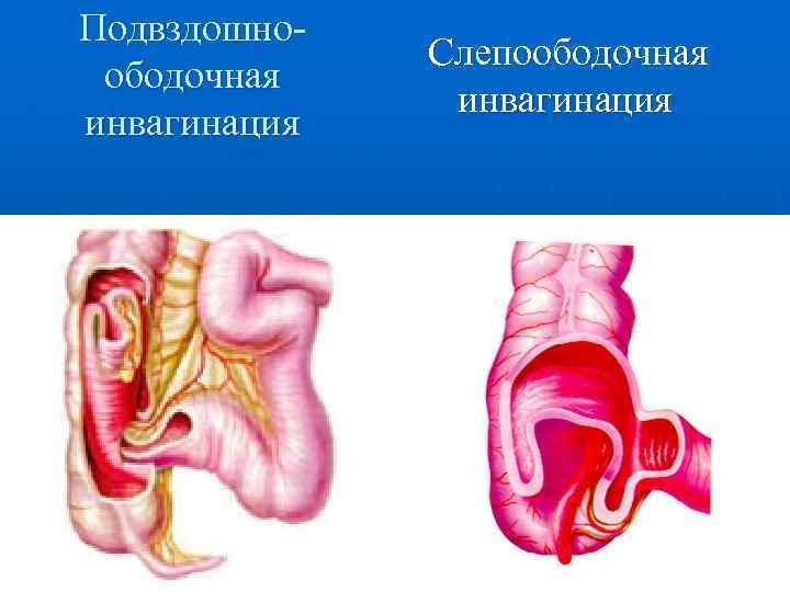 Подвздошноободочная инвагинация Слепоободочная инвагинация 