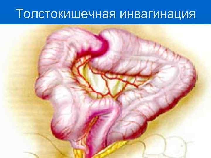 Толстокишечная инвагинация 