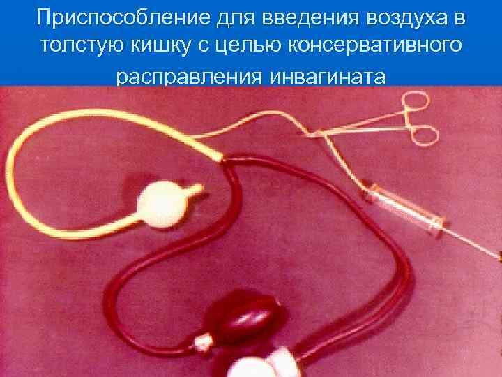 Приспособление для введения воздуха в толстую кишку с целью консервативного расправления инвагината 