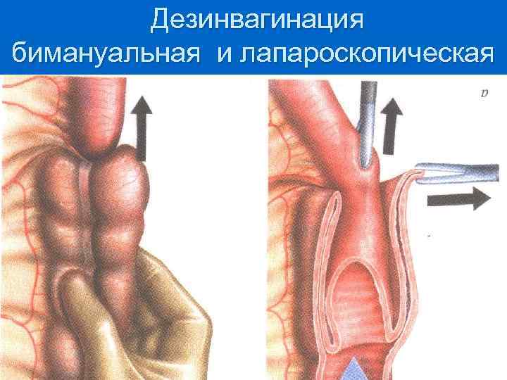  Дезинвагинация бимануальная и лапароскопическая 