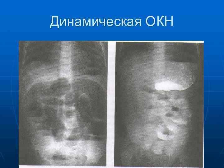 Динамическая ОКН 