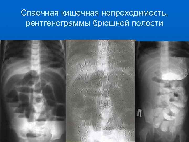 Спаечная кишечная непроходимость, рентгенограммы брюшной полости 
