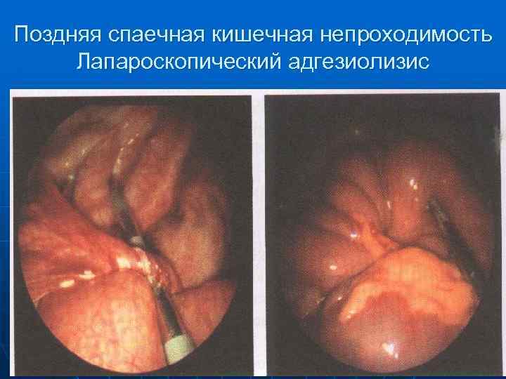 Поздняя спаечная кишечная непроходимость Лапароскопический адгезиолизис 