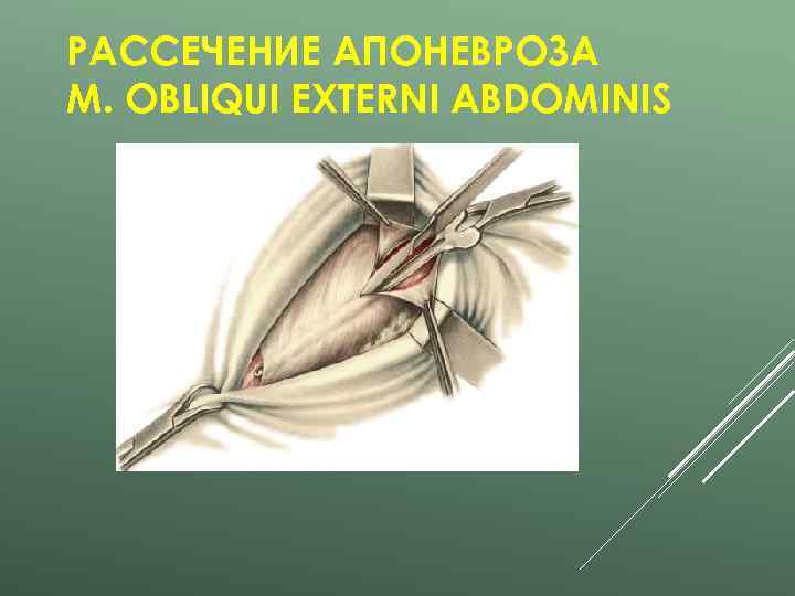 РАССЕЧЕНИЕ АПОНЕВРОЗА M. OBLIQUI EXTERNI ABDOMINIS 