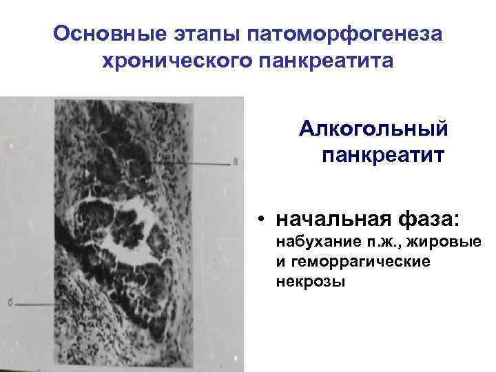 Основные этапы патоморфогенеза хронического панкреатита Алкогольный панкреатит • начальная фаза: набухание п. ж. ,