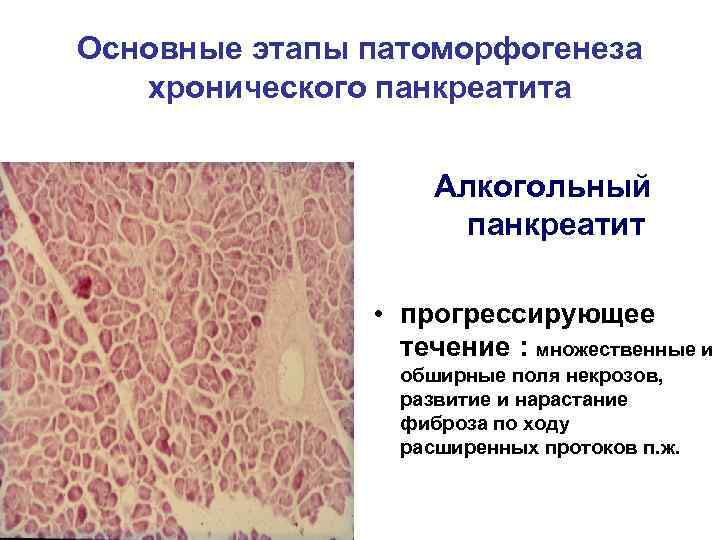 Основные этапы патоморфогенеза хронического панкреатита Алкогольный панкреатит • прогрессирующее течение : множественные и обширные