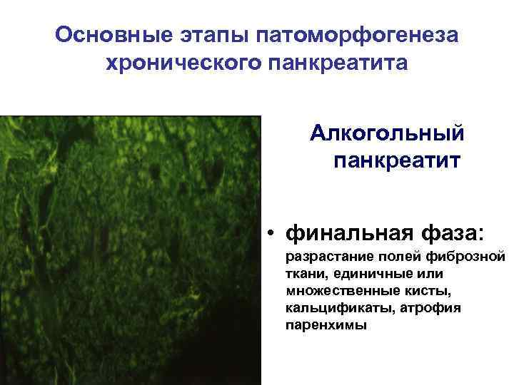 Основные этапы патоморфогенеза хронического панкреатита Алкогольный панкреатит • финальная фаза: разрастание полей фиброзной ткани,