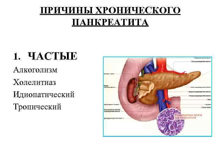 ПРИЧИНЫ ХРОНИЧЕСКОГО ПАНКРЕАТИТА 1. ЧАСТЫЕ Алкоголизм Холелитиаз Идиопатический Тропический 