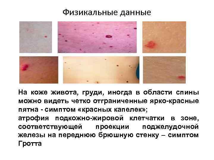 Физикальные данные На коже живота, груди, иногда в области спины можно видеть четко отграниченные