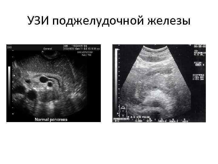 УЗИ поджелудочной железы 