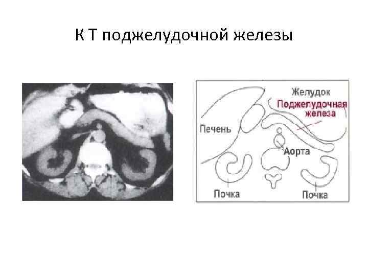 К Т поджелудочной железы 